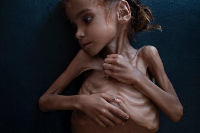 وفاة الطفلة اليمنية أمل حسين التي تشكل رمزا للمجاعه في بلادها